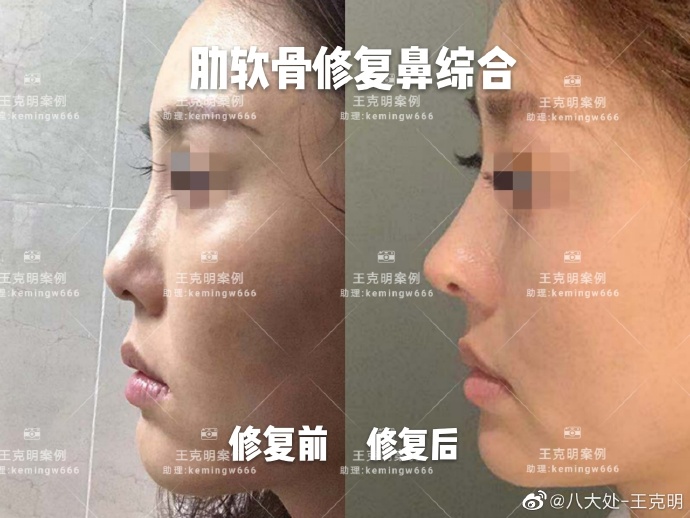 北京做鼻子做的最好的医生：李劲良和王克明谁好？