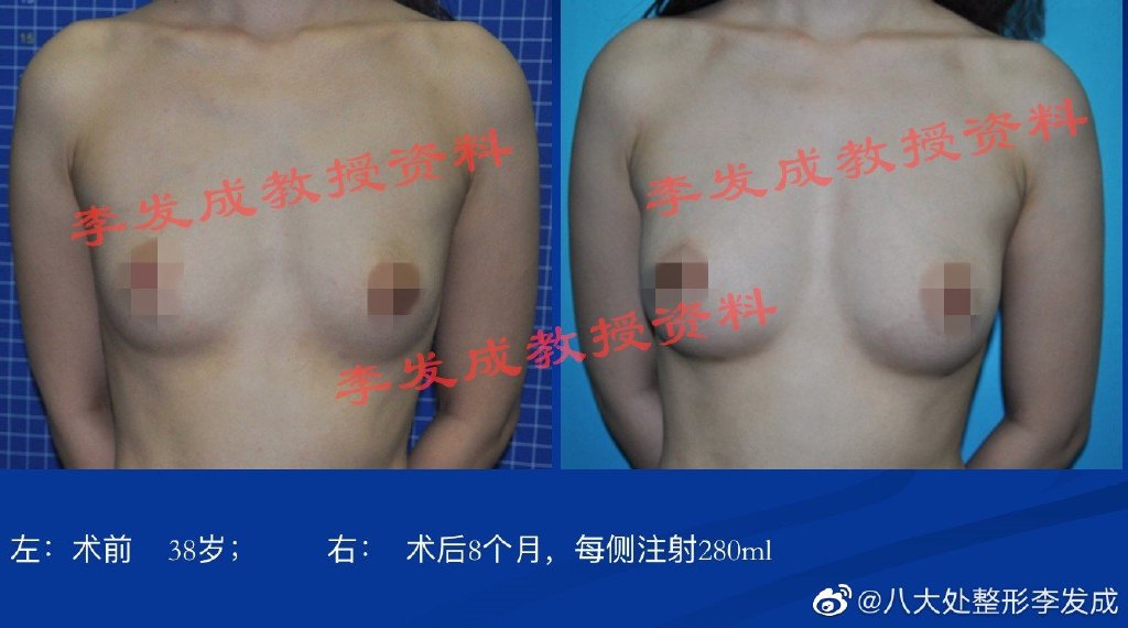 李发成脂肪隆胸案例