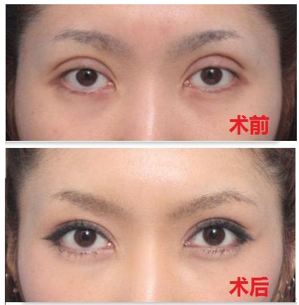 深圳双眼皮修复哪位医生比较好？深圳双眼皮修复专家排行榜