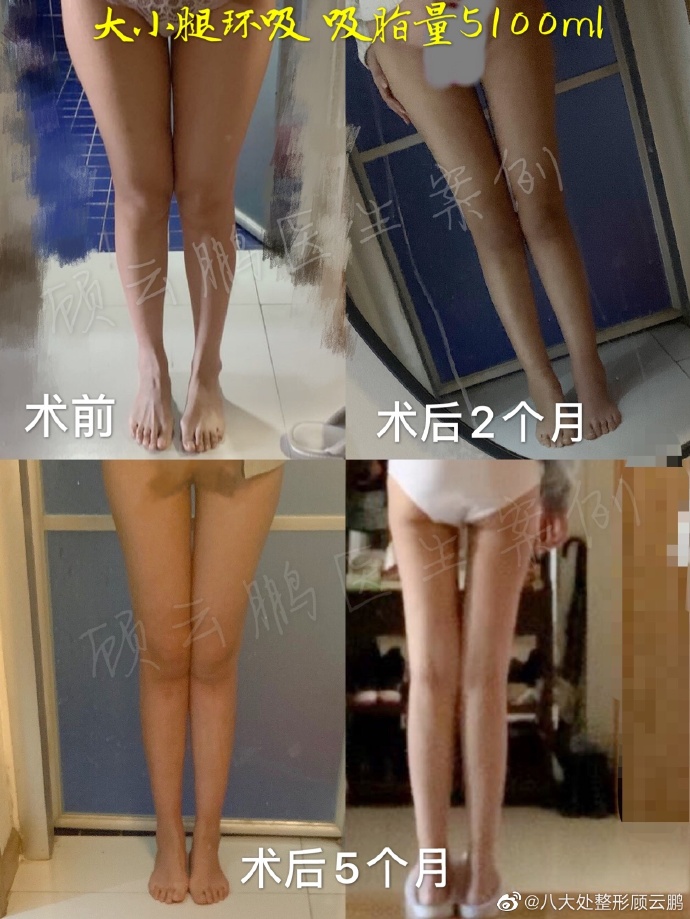 顾云鹏大小腿吸脂案例