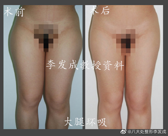 李发成大腿环吸案例