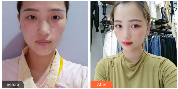 南京割双眼皮哪个医生比较好？