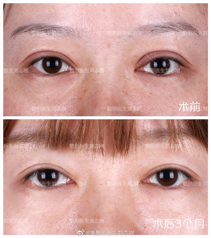 国内修复双眼皮专家哪个好？中国修复双眼皮医生预约排名前十名