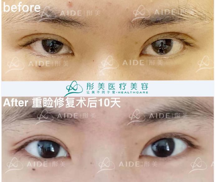 双眼皮修复专家张冰洁和刘风卓哪个好？