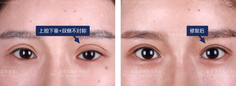 中国双眼皮修复专家排名谁最好？国内修复双眼皮排行榜前十名
