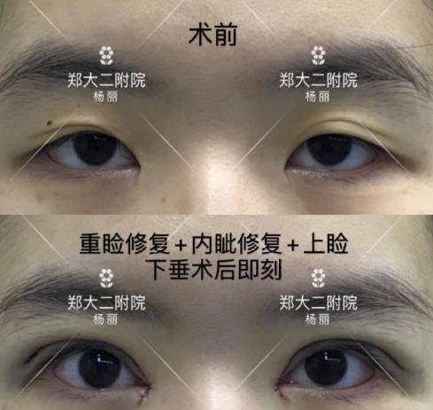 杨丽双眼皮修复案例
