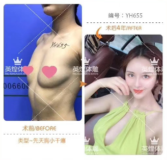 梁耀婵脂肪丰胸案例