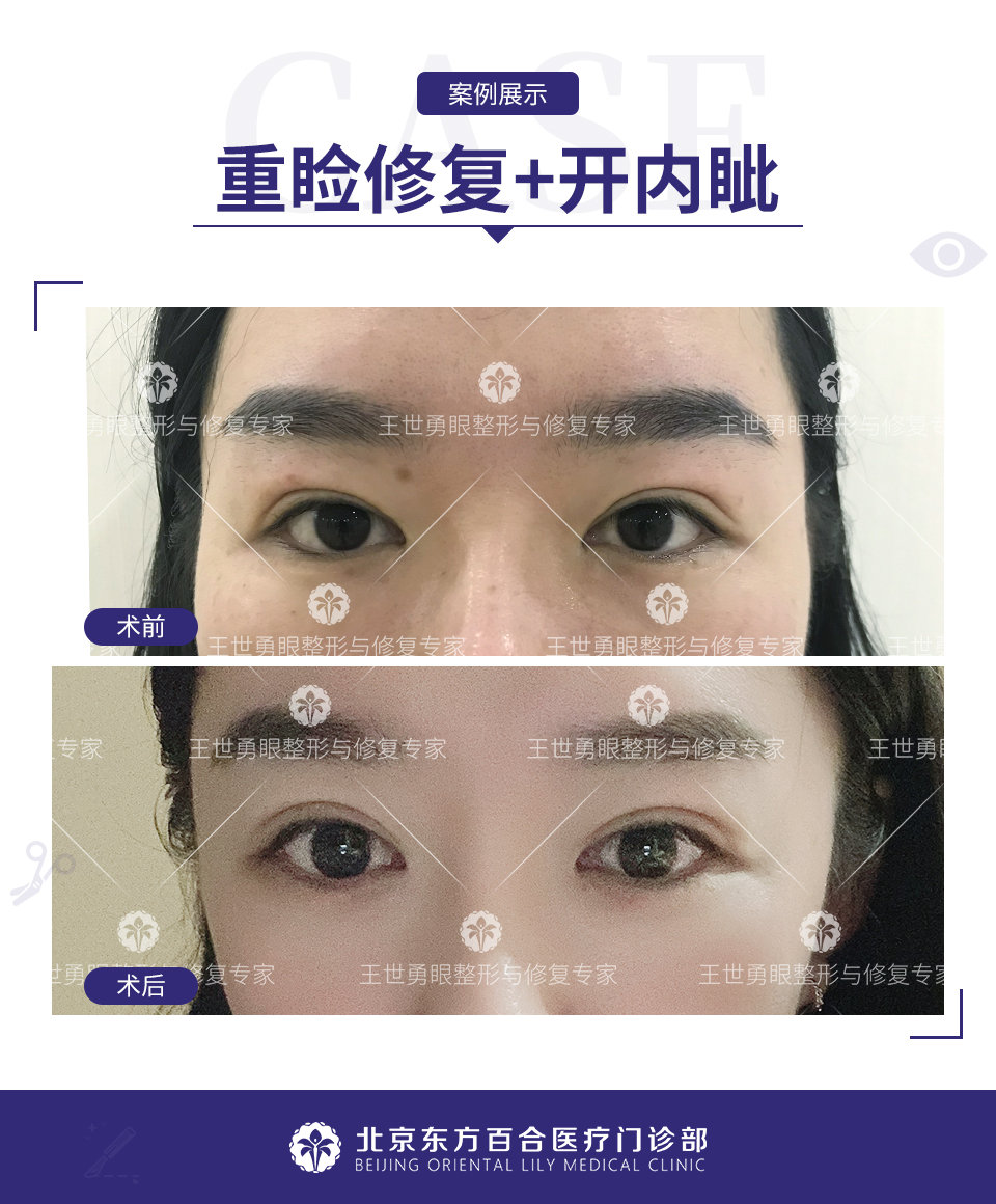 王世勇双眼皮修复案例