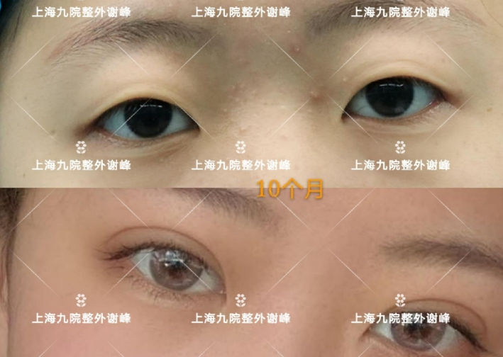 上海九院割双眼皮医生哪个最好？