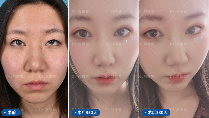 成都双眼皮修复专家刘辅容技术怎么样？