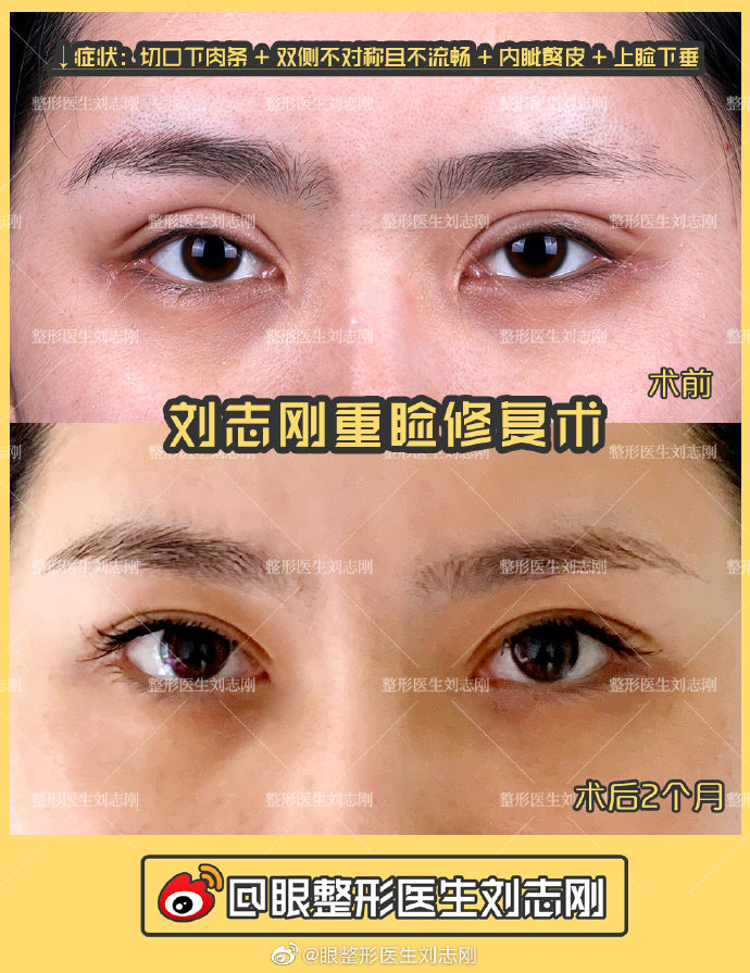 大连刘志刚高难度双眼皮修复案例