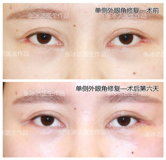 北京修复双眼皮的女医生有哪些？预约排名大全