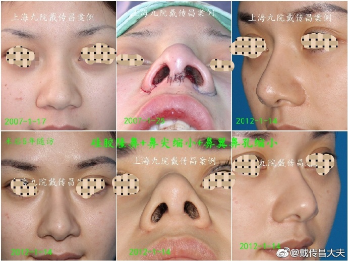上海鼻修复专家戴传昌鼻修复案例