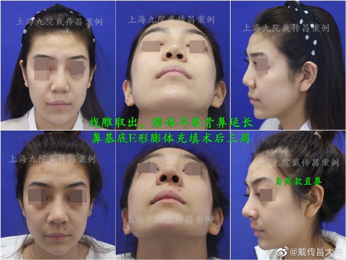 上海鼻修复专家戴传昌鼻修复案例