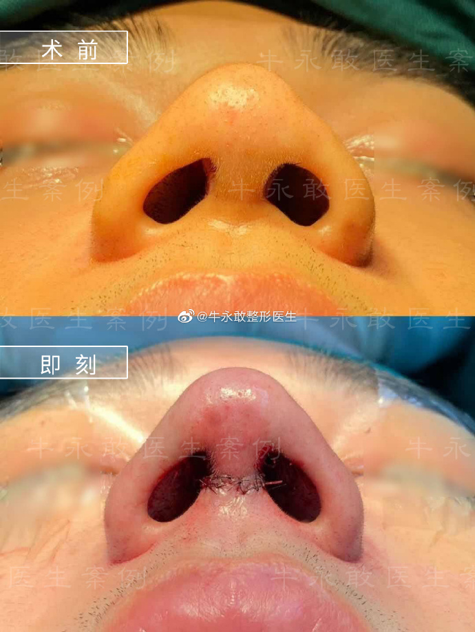 牛勇敢鼻修复案例