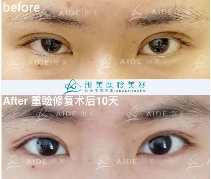 刘风卓王振军谁眼修复做的好？王振军刘风卓案例对比在线预约