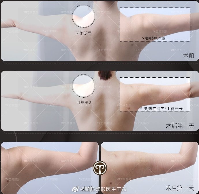 王东吸脂案例