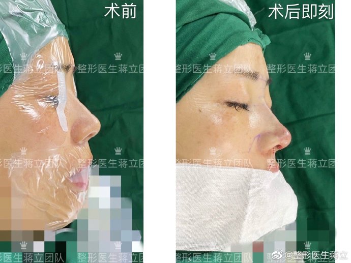 蒋立鼻修复案例