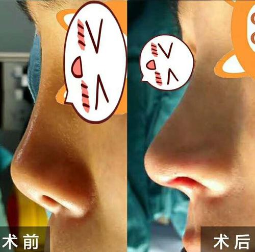 2020年中国鼻修复专家排名 2020年隆鼻修复医生预约排行榜