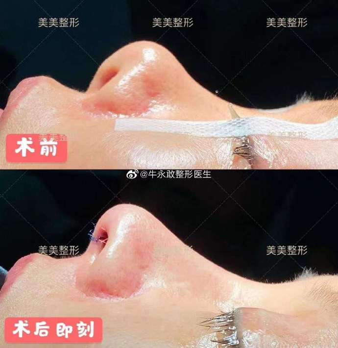 牛永敢修复鼻子怎么样？牛永敢隆鼻修复简介案例预约