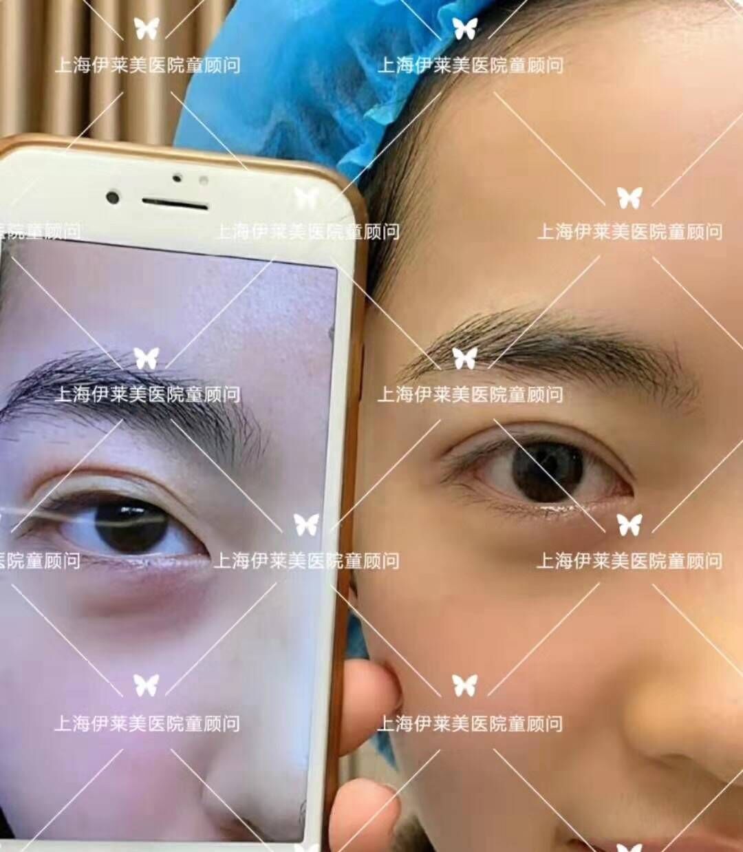 上海邱文苑和朱迪做眼综合谁好？朱迪邱文苑眼综合对比预约