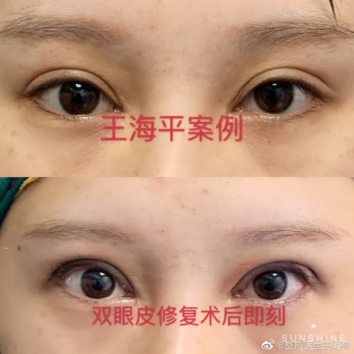 王海平和杨蓉哪个修复双眼皮做的好？