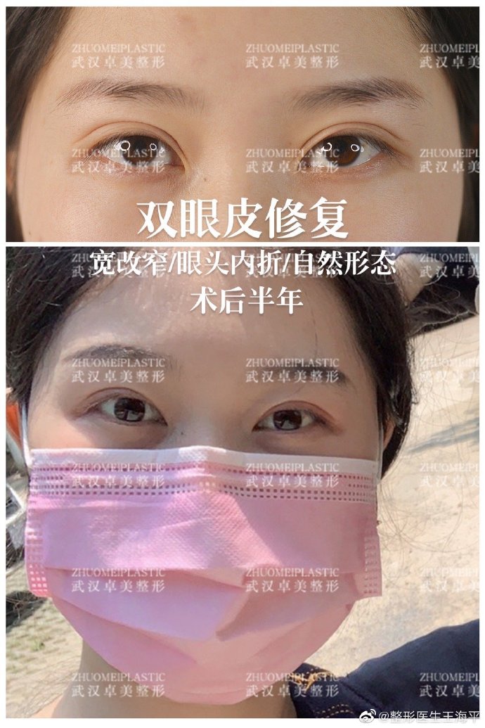 王海平和杨蓉哪个修复双眼皮做的好？