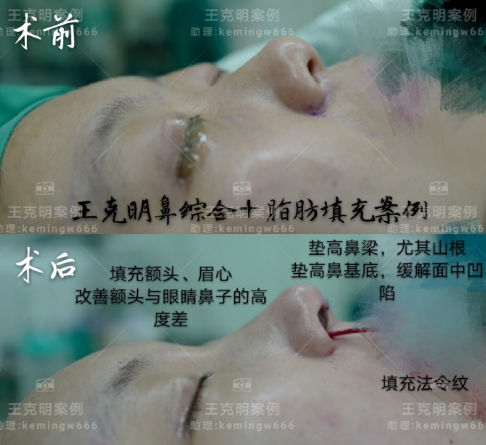 北京八大处隆鼻哪个医生做的最好？八大处隆鼻专家预约排名