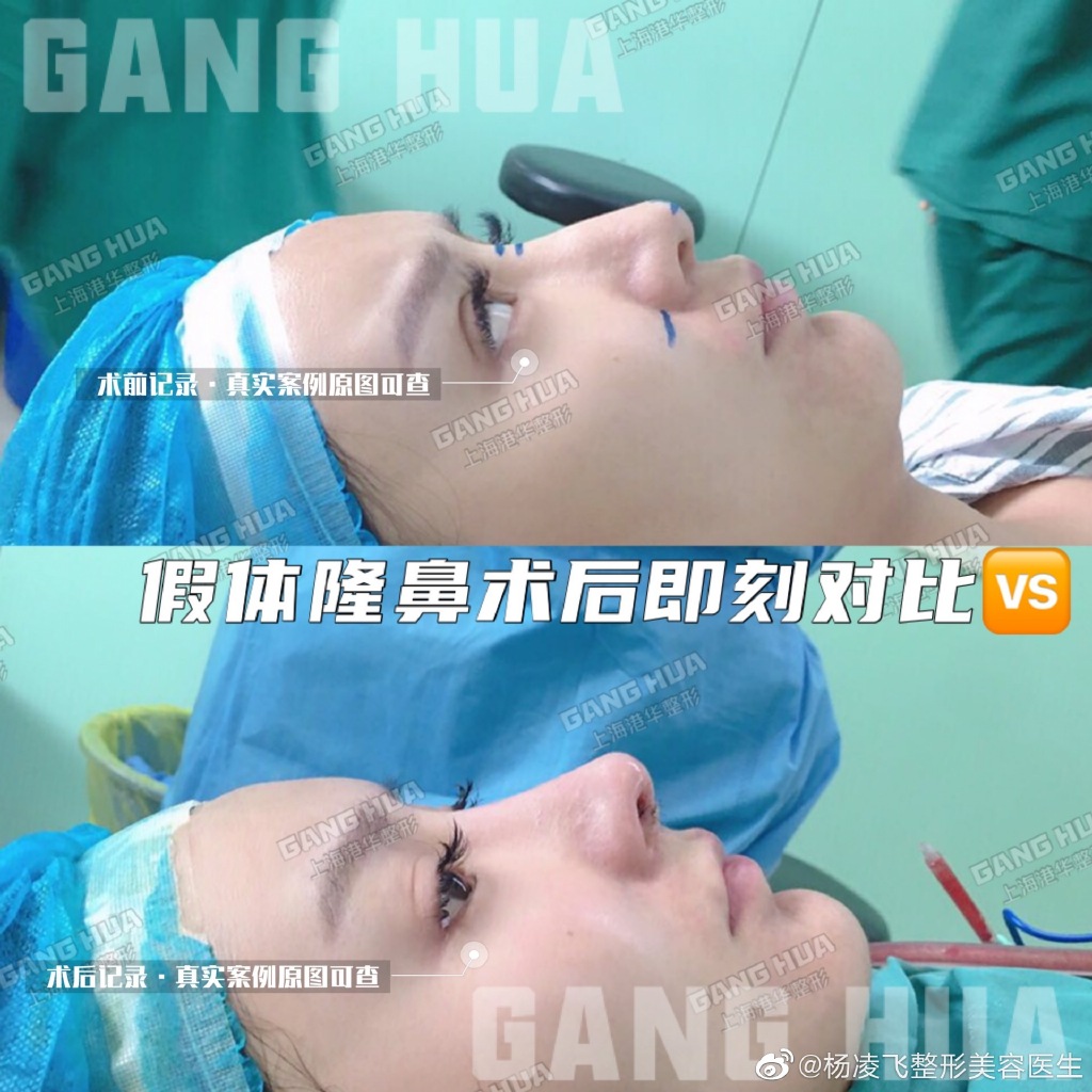 上海张毅和杨凌飞谁鼻子做得好？杨凌飞张毅案例对比预约