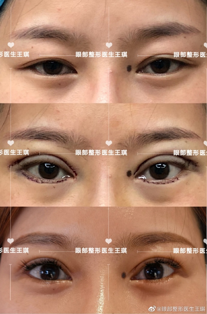 北京艺星王琪医生做的双眼皮怎么样？