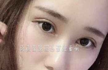 北京邦定刘桂莲割双眼皮技术怎么样？