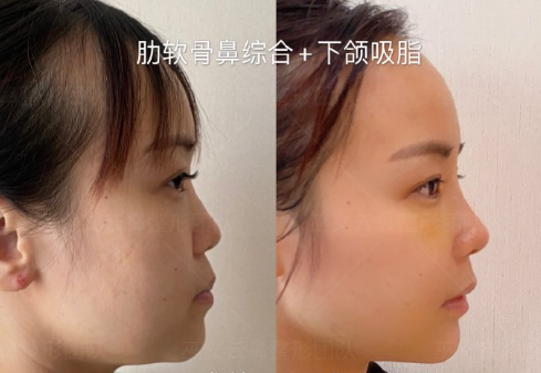 北京最有名气隆鼻专家是谁？隆鼻医生预约排行榜