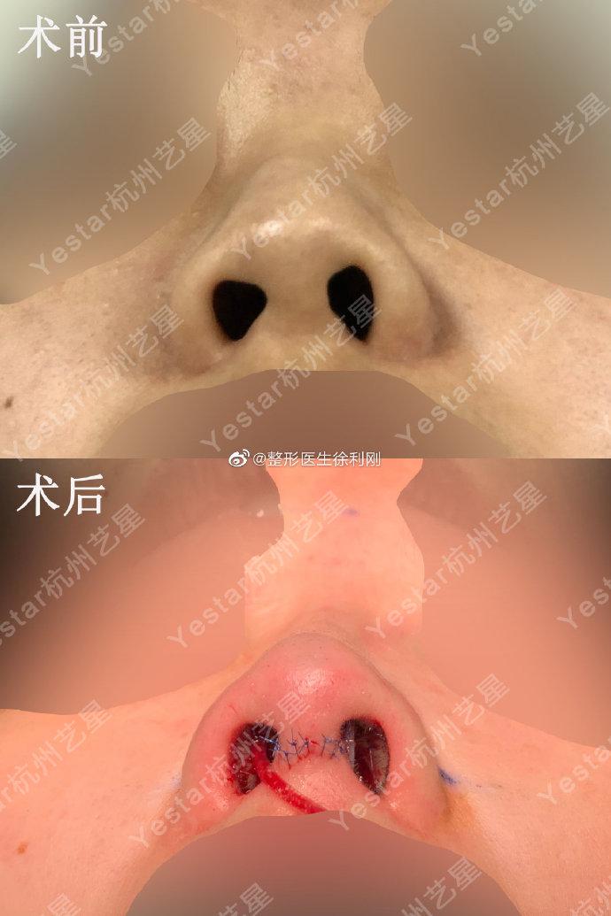 徐利刚和张龙谁做鼻子技术好？张龙徐利刚隆鼻医生谁技术好？