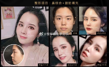 李劲良和李信锋哪个隆鼻好？李劲良和李信锋对比技术谁好？