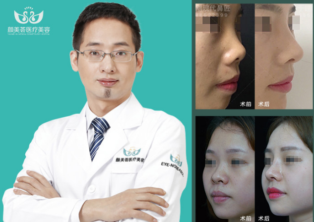 广州于建刚医生隆鼻技术怎么样？于建刚隆鼻简介案例预约
