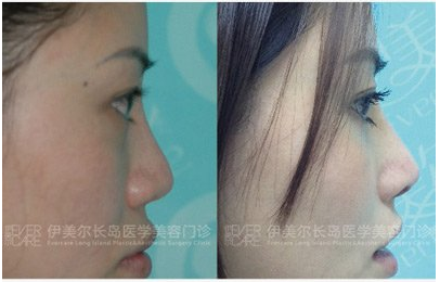 袁志玮鼻综合案例好看吗，隆鼻技术怎么样？