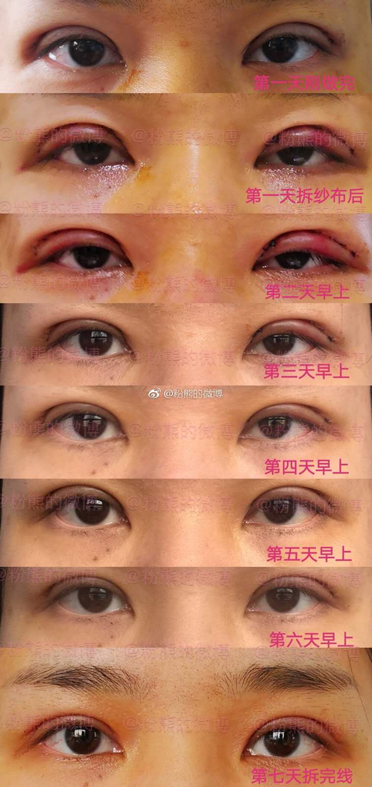 曹玮割双眼皮案例