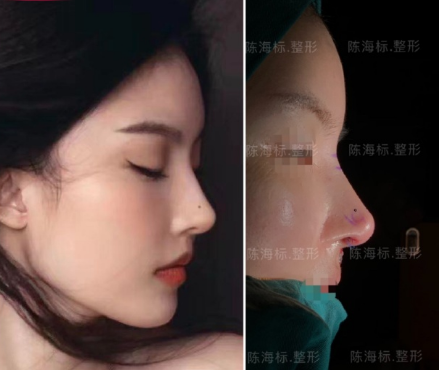 陈海标肋骨鼻案例