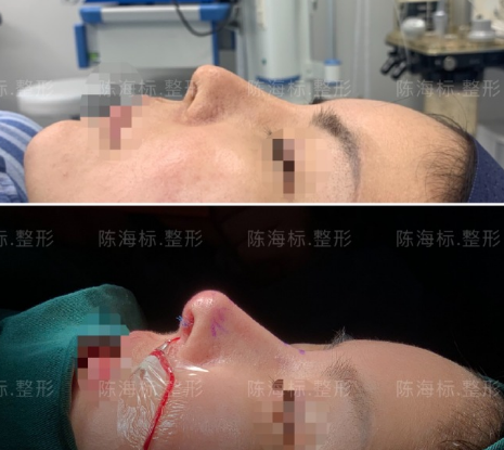 陈海标肋骨鼻案例