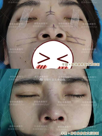 中国哪个医生取鼻子假体最厉害？