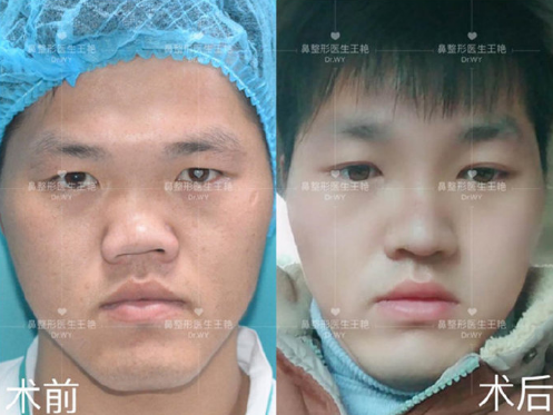 上海做畸形鼻修复的医生哪个好？上海畸形鼻专家排名