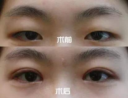 乌鲁木齐张伟双眼皮做的怎么样？乌鲁木齐张伟技术好吗？