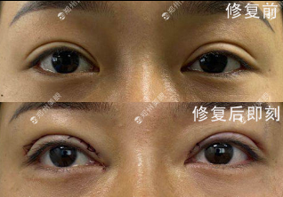 郑州眼修复田国静和杨丽哪个专业？杨丽田国静谁眼修复技术好？