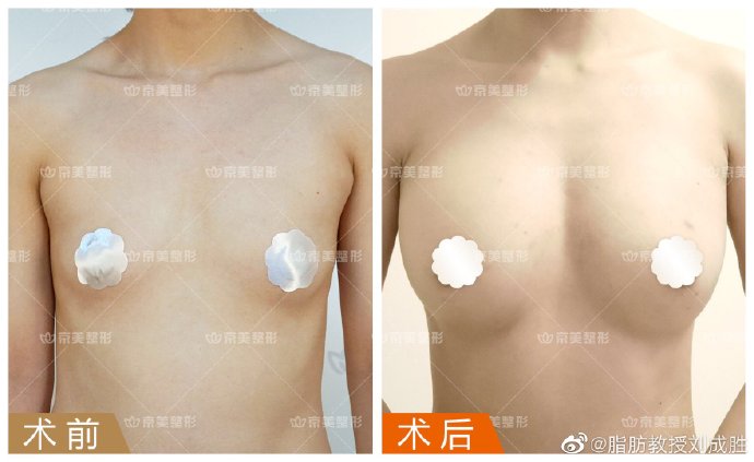 刘成胜丰胸案例