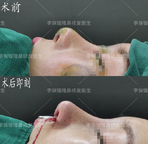 杭州鼻子修复最好的医生是谁？