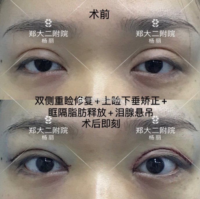 郑州修复双眼皮最好的医生是哪个？郑州眼修复专家排名大全
