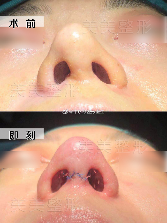 郑州有哪些做歪鼻比较好的医生牛永敢张洪波贺洁姜南谁好？