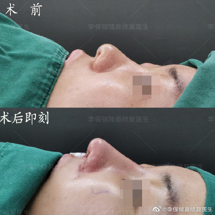 杭州鼻综合修复手术医生预约排名