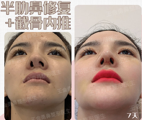 上海鼻修复专家最厉害和权威的是谁？