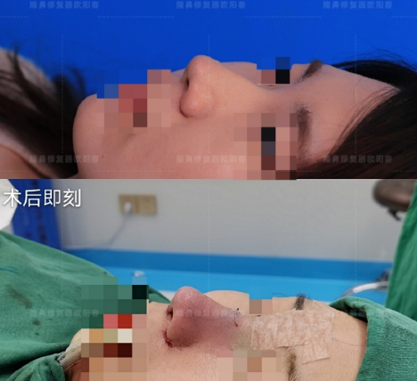 欧阳春鼻修复排名怎么样？欧阳春隆鼻修复简介案例预约